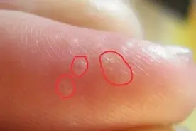 痒痒痒！一到夏天就长的这种“小水泡”到底是什么？图片