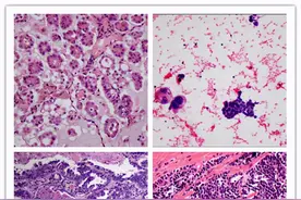 【白话病理系列2】走进病理世界--病理诊断图片