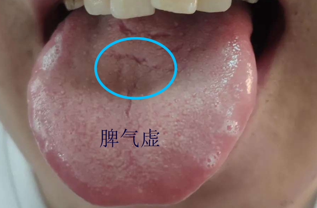 舌头开裂怎么办