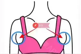 有副乳到底要不要手术呢？图片