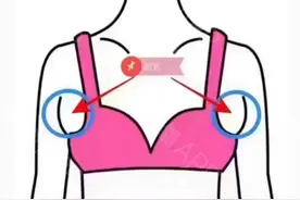 有副乳到底要不要手术呢？图片