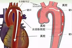 畅谈血管 迈向健康 | 徐鹏：胸部撕裂疼痛需警惕，可能是致命的主动脉夹层图片
