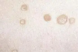 不痒不过敏的疹子，是HPV感染？医生：3分钟科普扁平疣与宫颈癌图片