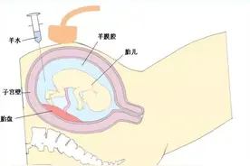 孕期被要求做羊水穿刺检查，到底在查什么？必查项目有哪些？图片
