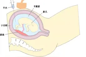 孕期被要求做羊水穿刺检查，到底在查什么？必查项目有哪些？图片
