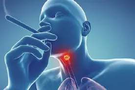 警惕！50岁男子咽喉异物感以为是咽炎，没想到竟是肿瘤图片