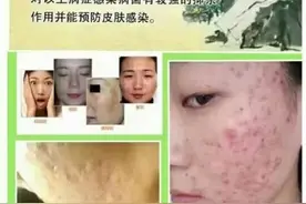 祛痘药膏正确的使用方法图片