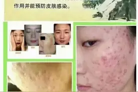 祛痘药膏正确的使用方法图片