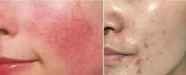 去粉刺毛囊炎痤疮鸡皮身体乳