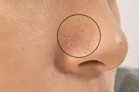 黑头1挤1个洞？错误的方法不要再用了图片