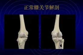 膝关节脱位，可以采取闭合复位，一般需要对关节内的血肿进行清除图片
