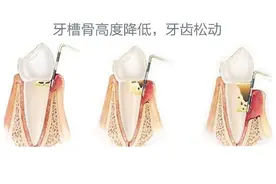 老年人牙槽骨吸收严重，是否可以做种植牙？图片