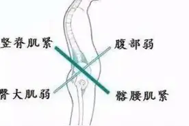 解决腰痛最简单有效的方法图片