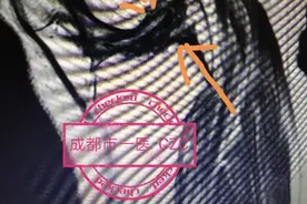 前叉胫骨止点撕脱骨折图片