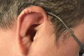 眼耳口鼻舌等五官也能患痛风？耳廓痛风石和痛风性眼病并不少见图片