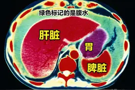当亲人送入ICU，都会遭受到哪些“酷刑”图片