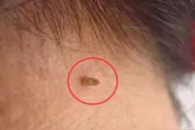 脖子、腋下长的“小肉粒”是什么？影响健康吗？带你了解图片