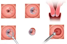 女性朋友！除了“泡沫样”白带，这7种阴道分泌物也要注意图片