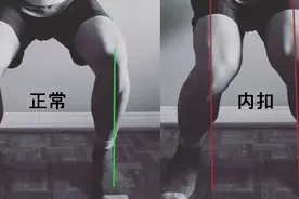 危机四伏“膝内扣”——暗示全身多处急需修正图片