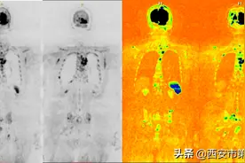 航天城院区医学影像中心开展全身类PET检查图片