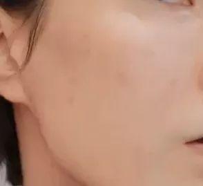 毛周角化症的地方能纹身吗