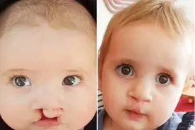 导致婴儿出现兔唇的四大原因，孕妇不得不了解！图片
