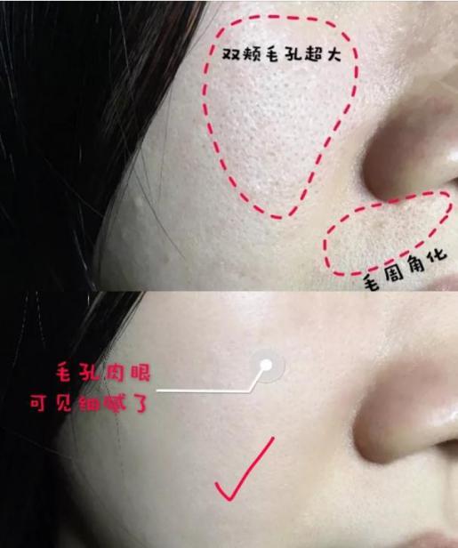 去粉刺毛囊炎痤疮鸡皮身体乳