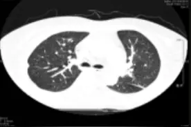 妇女体重骤降发热1月，无特异性表现令诊断陷僵局，感染？肺癌？图片
