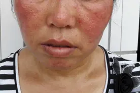 小心毁容！这些药膏可致激素依赖性皮炎，禁用于面部，附药膏名单图片