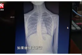 14岁少女脊柱呈“S”型，竟是因为这个习惯？家长们要注意了视频封面