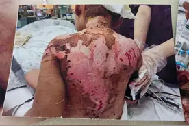 开水烫头打火机烧嘴喂猫粮，抚顺6岁女童被母亲男友虐至生命垂危，姥姥收到死亡威胁，母亲称是洗澡烫的图片