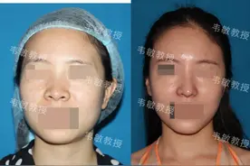 形态欠佳扁塌鼻如何变的秀气挺拔图片
