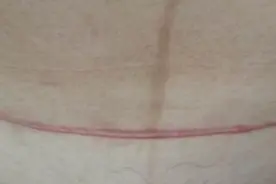 同样是剖腹产，为啥明星的肚子就看不出疤痕？主要是这几点做得好图片