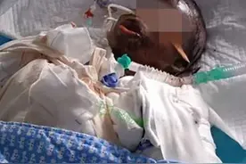 14岁女孩模仿短视频被重度烧伤 家人：孩子吃完饭就看手机图片