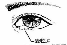 得了麦粒肿千万不能挤、不能挤、不能挤！图片