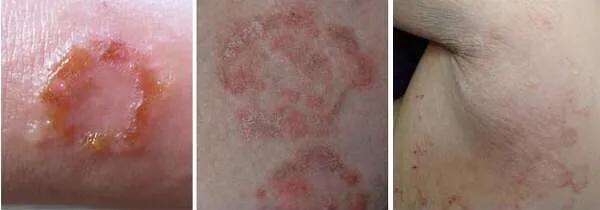 痒痒痒，常见的7种皮肤病用药大全！