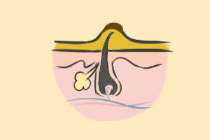 尿素霜涂在鸡皮肤上有点痛