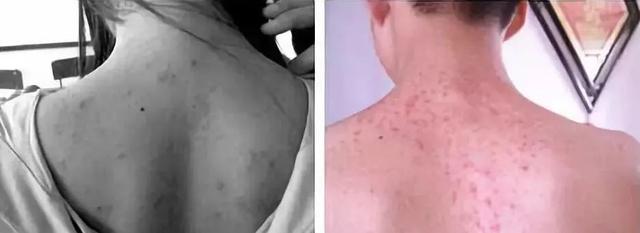 鸡皮肤治疗神器