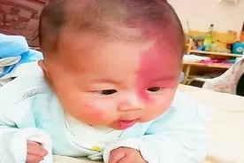 为什么宝宝总容易长胎记？产科医生：孕期尽量避免这3种行为图片