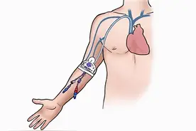 输液过“隧道”，舒心又安全！图片