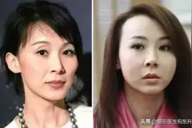 苹果肌不能这么填，填完老十岁？图片