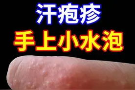 手指缝、脚趾缝、脚底板总长透明小水泡，很痒总想抠？一文说清图片