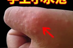手指缝、脚趾缝、脚底板总长透明小水泡，很痒总想抠？一文说清图片
