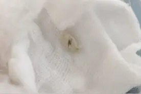 医生误诊了，根本不是耳疖肿图片