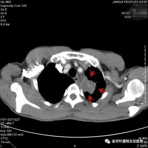 叶建明谈结节：检查发现肺实性结节怎么办？个人版实用指南