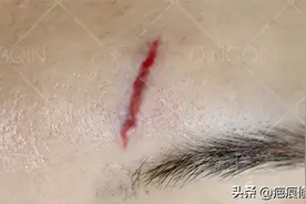 脸上受伤不想留疤怎么做？拒绝破相，疤痕拜拜图片