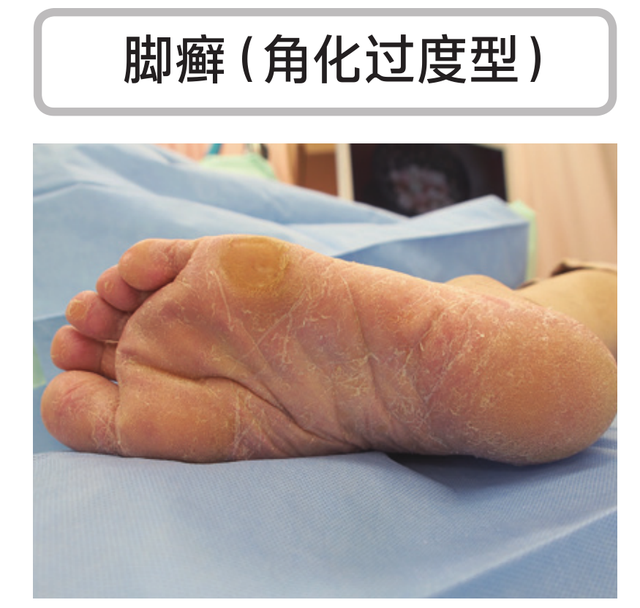 角化过度型足癣脂肪肝