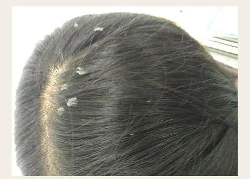 头皮上抠出油脂粒