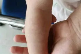 郴州一医治疗血管瘤，拯救天使童颜图片