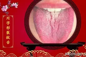 老中医讲透舌诊之裂纹舌舌象高清图谱解说图片